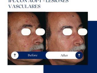 Tratamiento varices antes y después - 875065