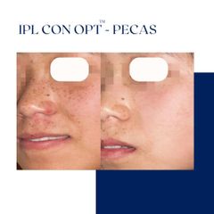 Ghorchi Clinic - IPL