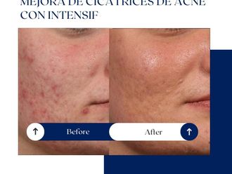 Tratamiento antiacné antes y después - 875068