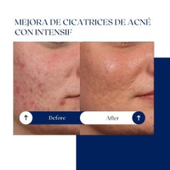 Ghorchi Clinic - Acné