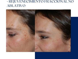 Rejuvenecimiento facial antes y después - 875070