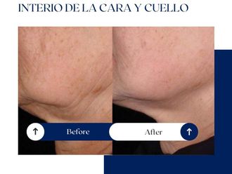Rejuvenecimiento facial antes y después - 875072