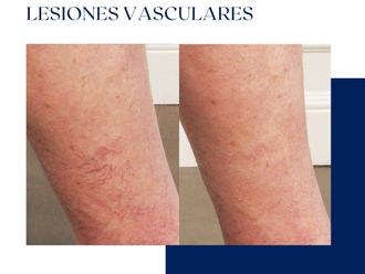 Láser vascular antes y después - 875073