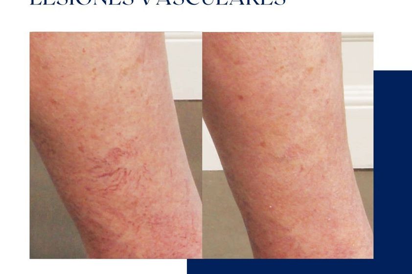 Láser vascular antes y después - 875073