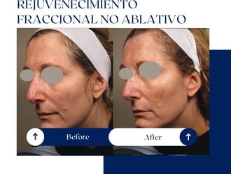Rejuvenecimiento facial antes y después - 875074