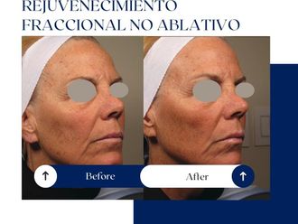 Rejuvenecimiento facial antes y después - 875075