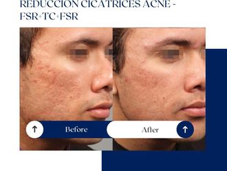Corrección cicatrices antes y después - 875076