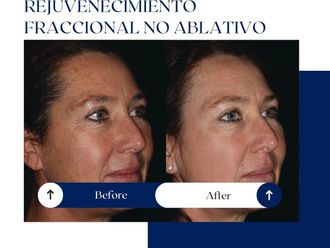 Rejuvenecimiento facial antes y después - 875077