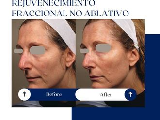 Rejuvenecimiento facial antes y después - 875078