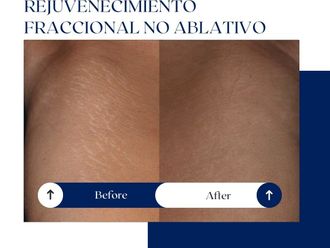 Rejuvenecimiento facial antes y después - 875132
