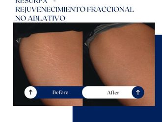 Eliminación de estrías antes y después - 875133