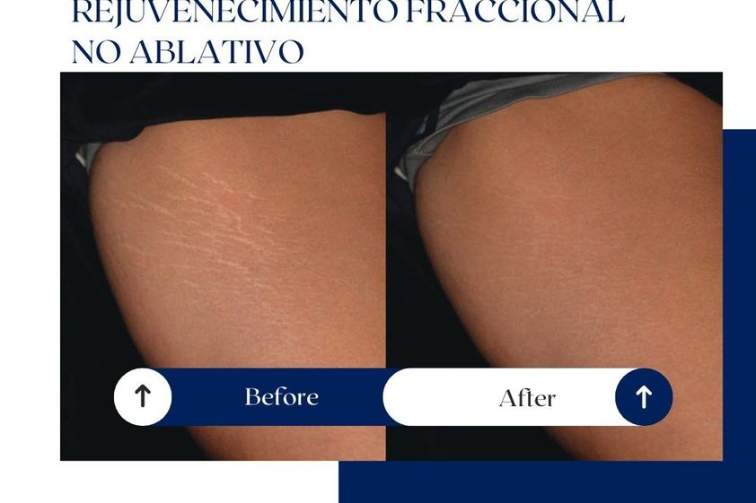 Eliminación de estrías antes y después - 875133