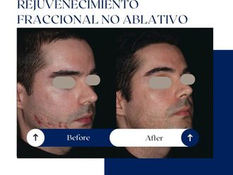 Rejuvenecimiento facial antes y después - 875134