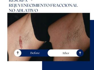 Corrección cicatrices antes y después - 875135