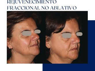 Rejuvenecimiento facial antes y después - 875136