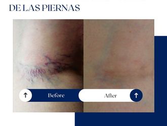 Láser vascular antes y después - 875137
