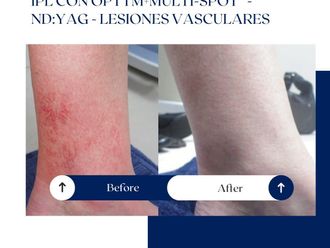 Láser vascular antes y después - 875138