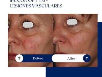 Láser vascular antes y después - 875139