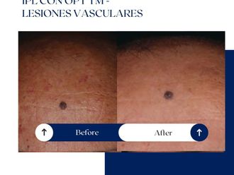 Láser vascular antes y después - 875141