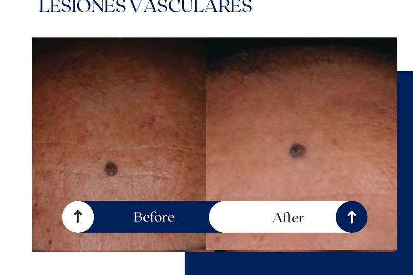 Láser vascular antes y después - 875141