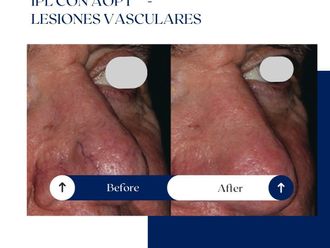 Láser vascular antes y después - 875210