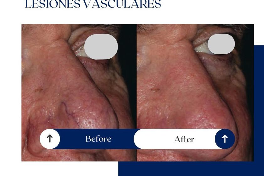 Láser vascular antes y después - 875210