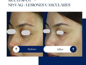 Láser vascular antes y después - 875211