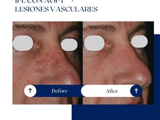 Láser vascular antes y después - 875212