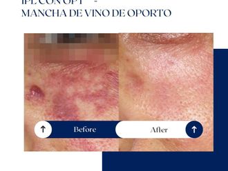 Tratamiento antimanchas antes y después - 875213