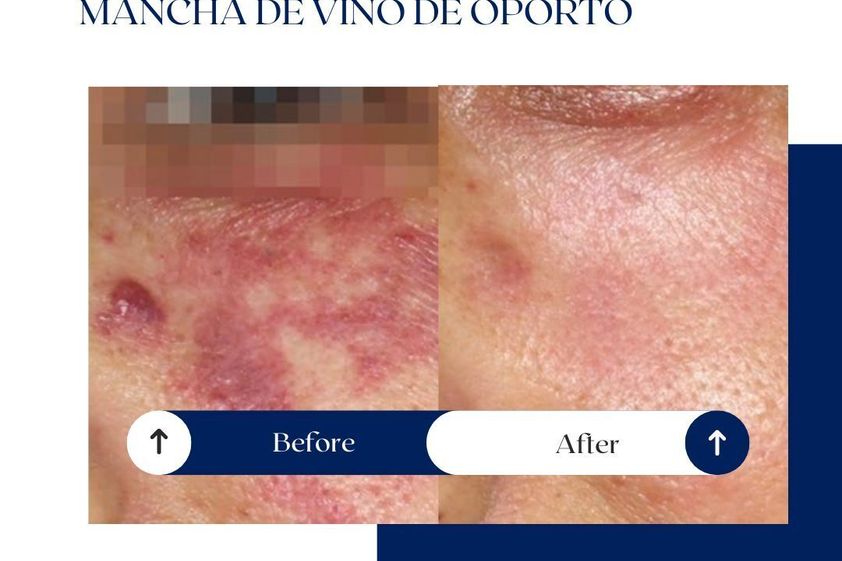Tratamiento antimanchas antes y después - 875213