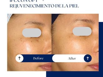 Rejuvenecimiento facial antes y después - 875216