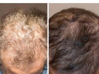 Tratamiento capilar antes y después - 875421