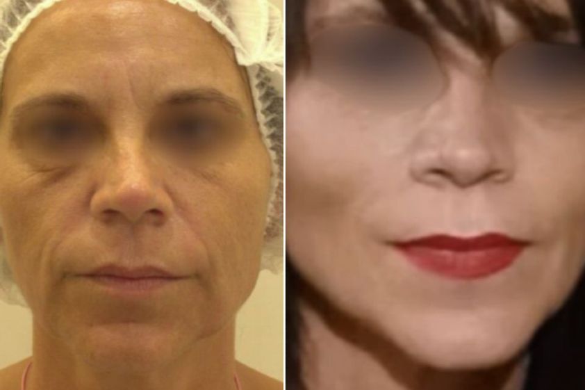 HIFU antes y después - 875422