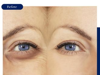 Eliminación ojeras antes y después - 875423