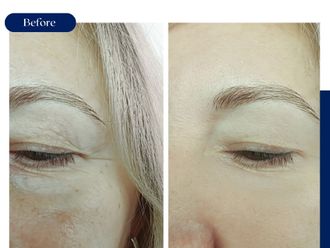 Eliminación ojeras antes y después - 875424