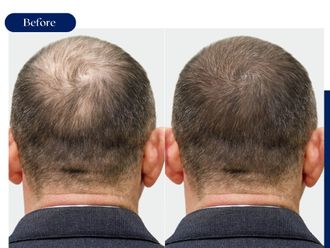 Tratamiento capilar antes y después - 875425