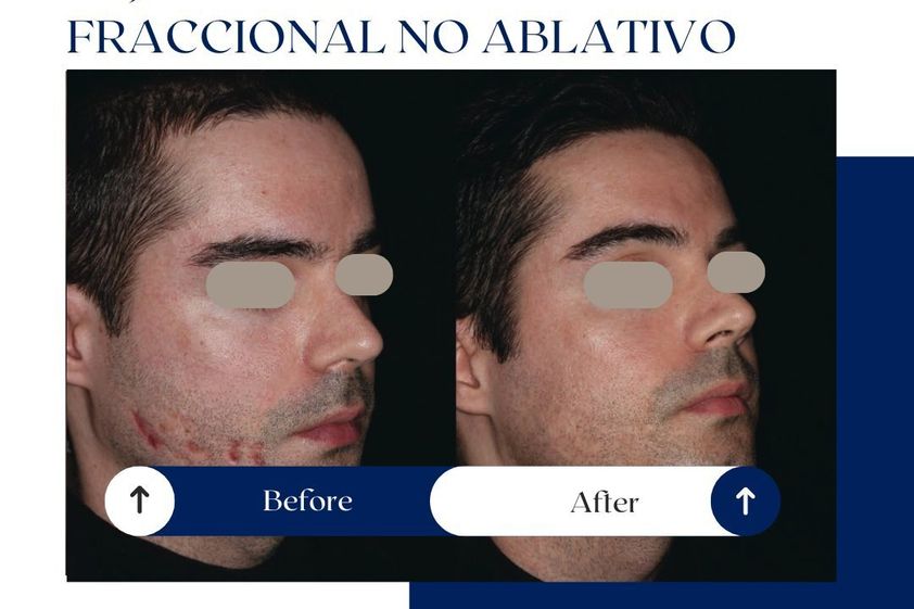 Tratamiento antiacné antes y después - 875736