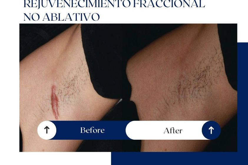 Corrección cicatrices antes y después - 875737