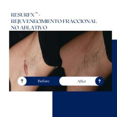Ghorchi Clinic - Corrección de cicatrices