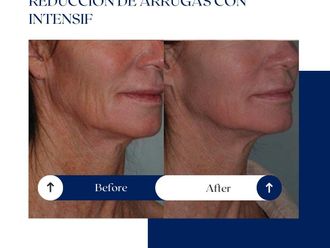 Rejuvenecimiento facial antes y después - 875818