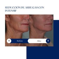 Ghorchi Clinic - Reducción de arrugas con Intensif