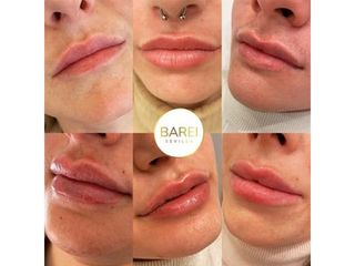 Aumento labios - Clínica Barei