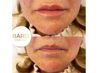 Aumento labios - Clínica Barei
