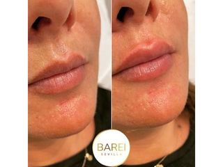Aumento de labios - Clínica Barei