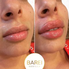 Aumento de labios - Clínica Barei