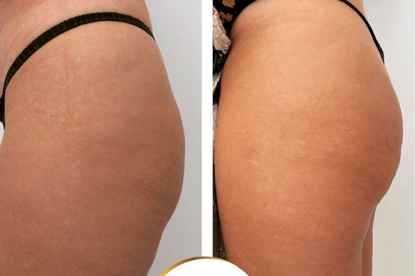 Aumento glúteos antes y después - 823838