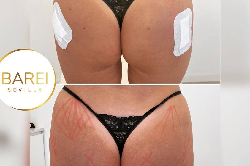 Celulitis antes y después - 828032