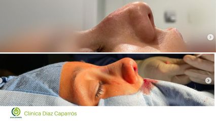 Rinoplastia - Clínica Díaz Caparrós