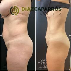 Liposucción - Clínica Díaz Caparrós