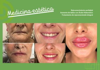 Aumento de labios - Clínica Díaz Caparrós